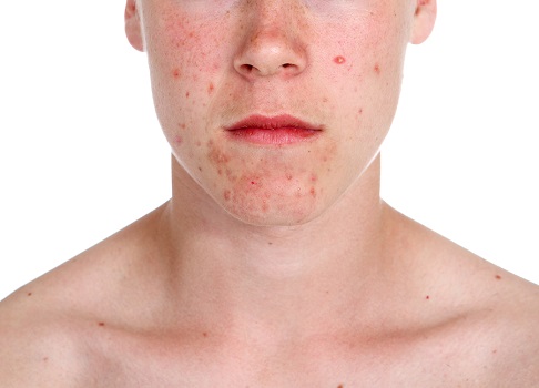 Acne Treatment Options dermatology alamo heights san antonio texas
