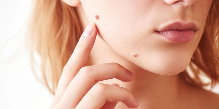 mole removal dermatology alamo heights san antonio texas