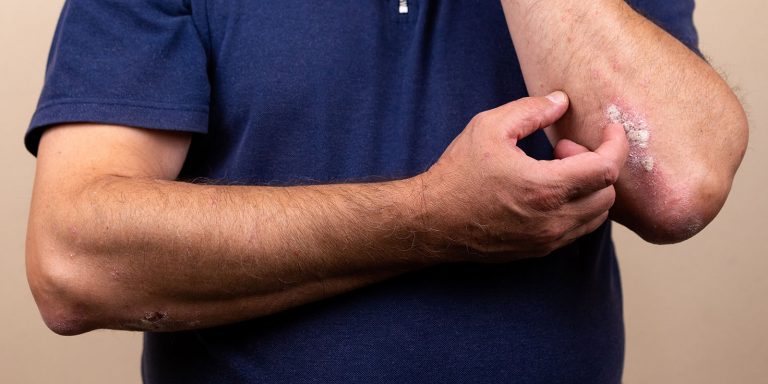 psoriasis dermatology alamo heights san antonio texas