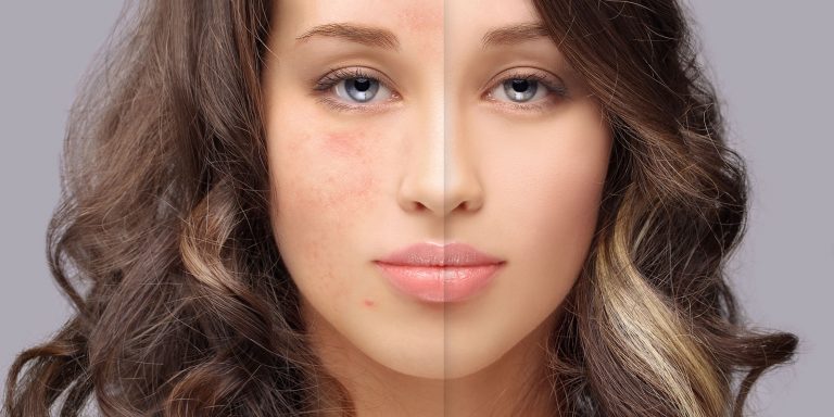 Rosacea dermatology alamo heights san antonio texas