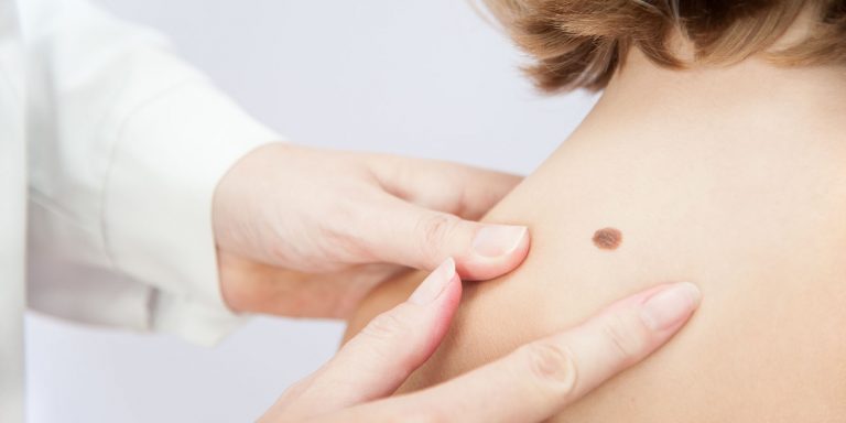 skin cancer dermatology alamo heights san antonio texas